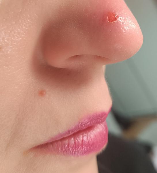 Odretá koža na nose