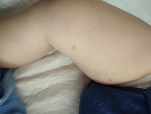 Môže očkovanie spôsobiť zvýšenú teplotu?