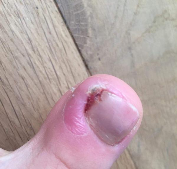 Stále sa obnovujúci kožný problém na palci nohy 