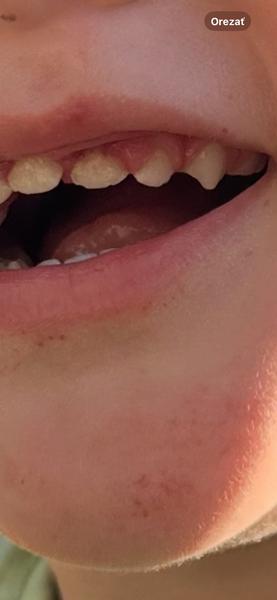 Posunutý zub po páde