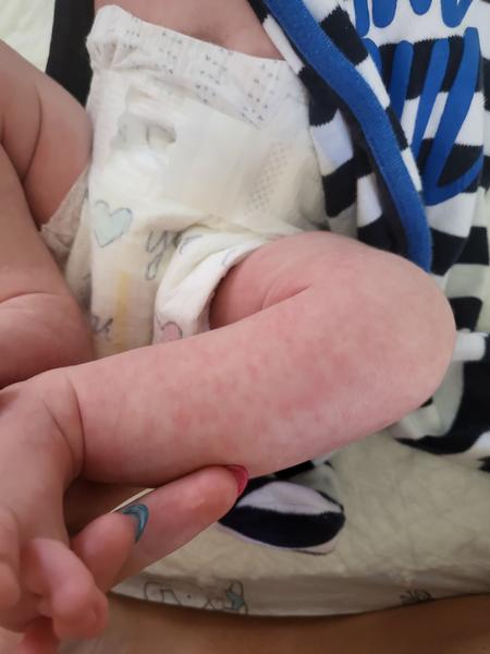 Aký výsyp má moje dvojtýždňové dieťatko?