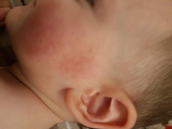 Vyhádzané líca, 17 mesačný syn