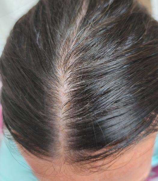 Čo môžu znamenať hnedé fľaky vo vlasoch?