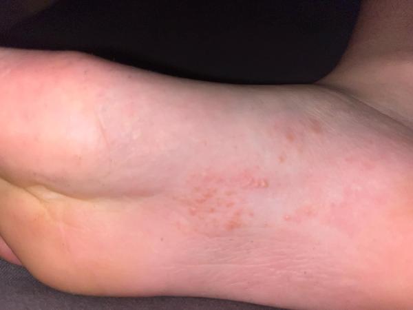 Čo môžu znamenať vyrážky na nohe u detí?