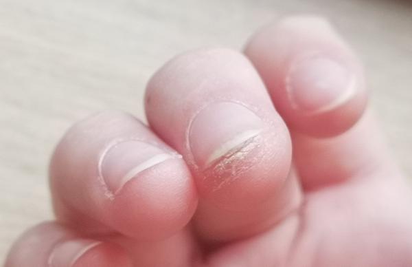 Čo sa mi to stalo s prstom?