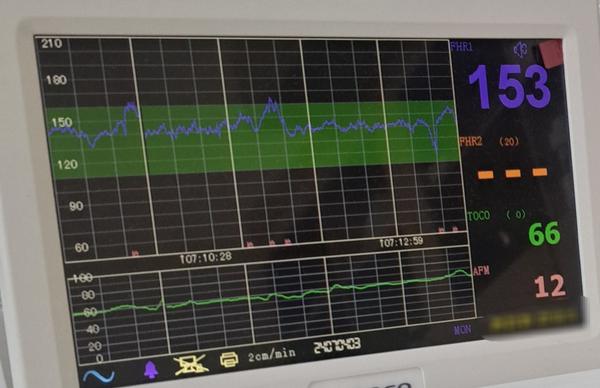 Vyzná sa niekto v CTG zázname plodu?