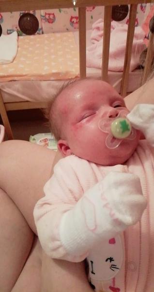 Alergia alebo novorodenecké akné ?