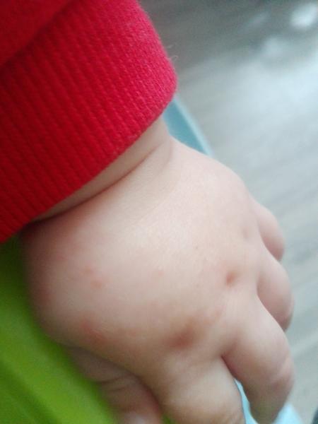 Aké vyrážky má môj 10 mesačný syn na tvári?