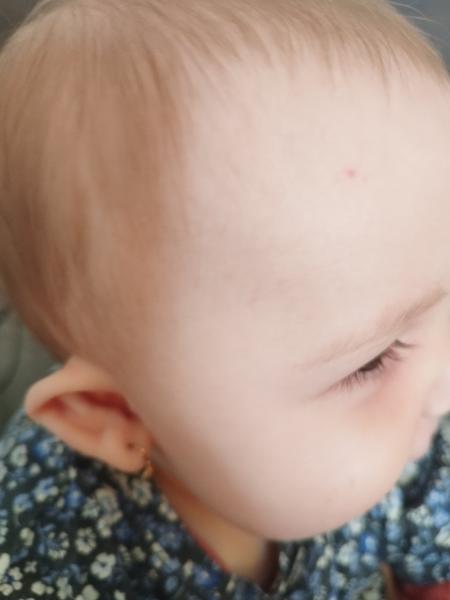 Sú to osýpky alebo kiahne?