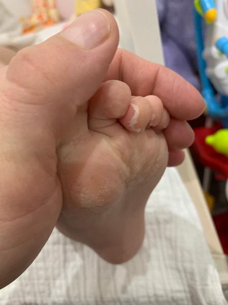 Štvorročnej dcére sa olupujú pršteky na nohách. Ide o mykózu?