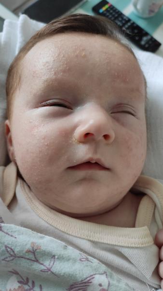 Ako pomôcť 6-týždňovej dcérke, ktorá má seboreickú dermatitídu?