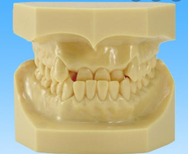 Obrátený podkus u 12 ročnej dcéry