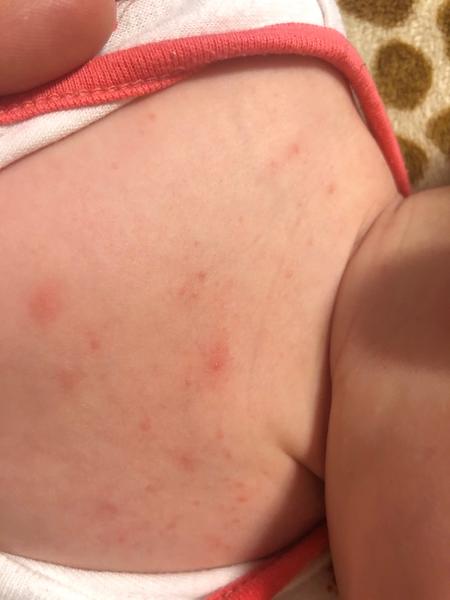 Čo dať 7-týždňovému na výsyp na hrudi?