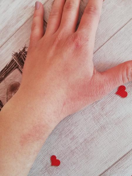 Zvyknú sa mi robiť krvavé ranky a strašne ma štípu ruky