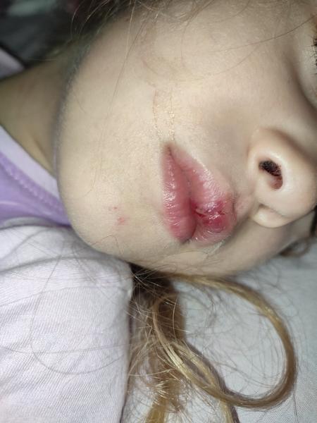 Úraz na bicykli: Ako liečiť narazené zuby a pery?