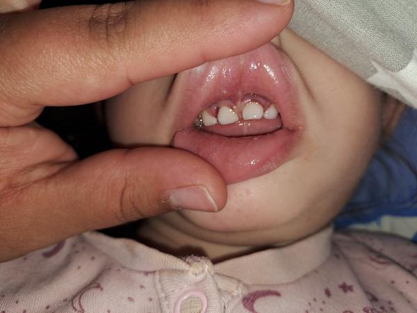 Problém so zúbkami po úraze