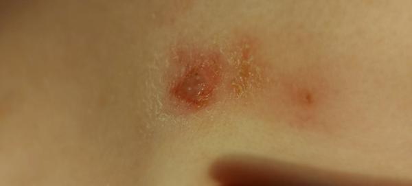 O aký kožný problém tu ide?