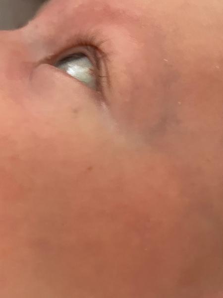 Aká je správna liečba prasknutej cievky u 3-mesačného syna?