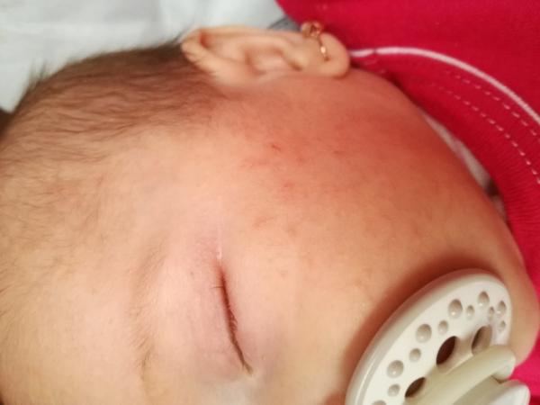 Vyrážky na tvári dvojmesačného bábätká
