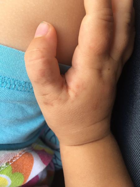 Aké fľaky na rukách má moja trojročná dcéra?