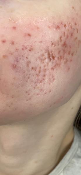 Skúsenosti s laserom na jazvy po akné