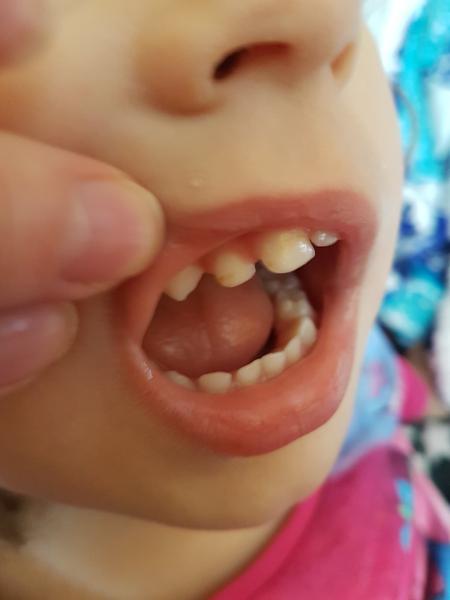 Problémové predné zúbky trojročnej dcérky