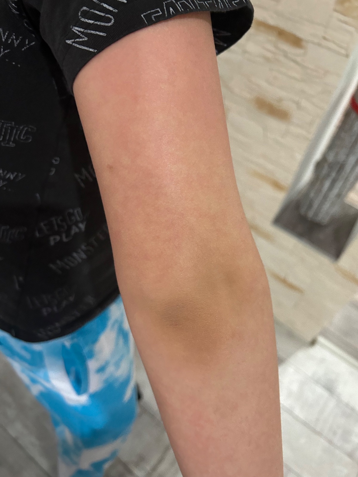 Je to piata choroba alebo osýpky? Modrý koník