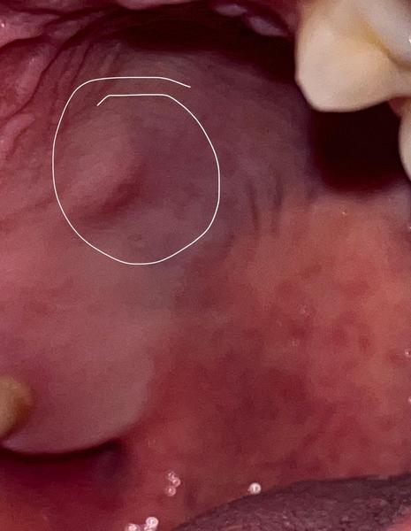 Hrbolček na podnebí