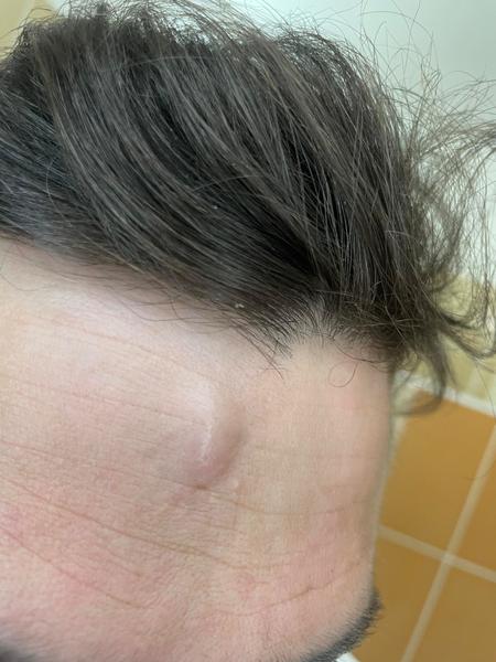 Čo znamená hrčka na čele môjho manžela?