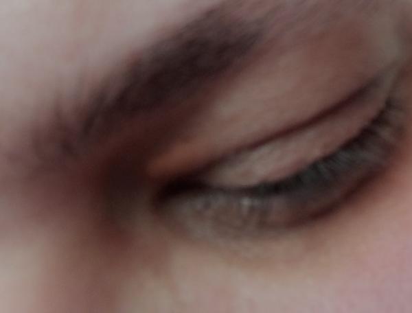 Je oranžová škvrna na viečku nebezpečná?