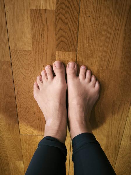 Je to hallux alebo len spadnutá klenba?