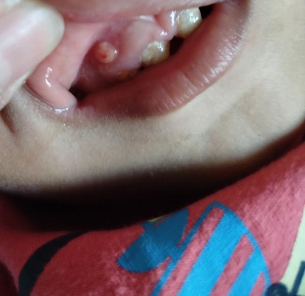 Čo je to za útvar v ústach dieťaťa?