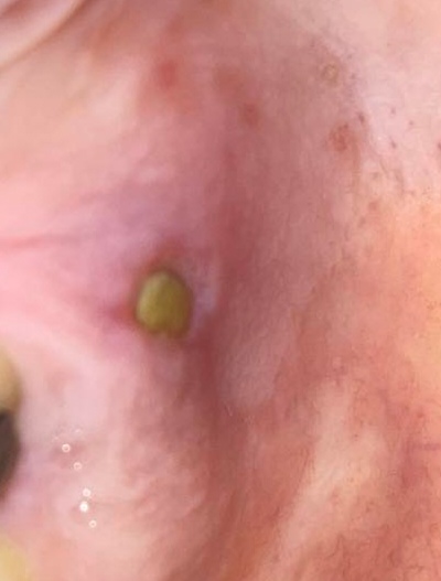 Čo spôsobuje opuch nad horným zubom?