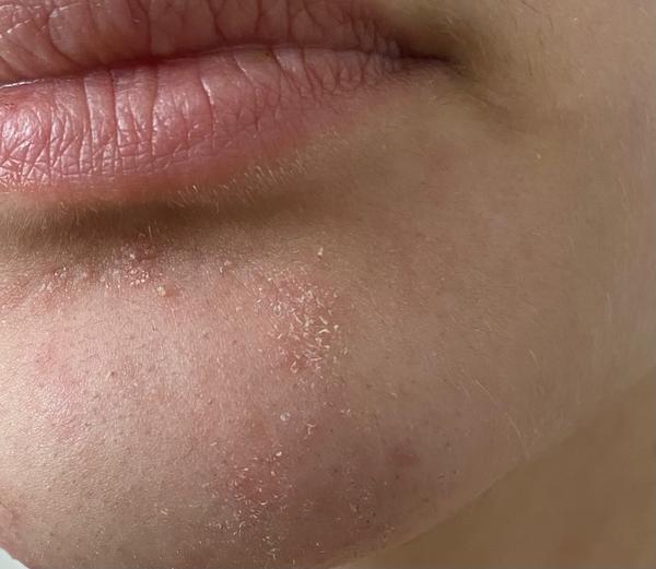 Je toto začínajúca psoriáza?