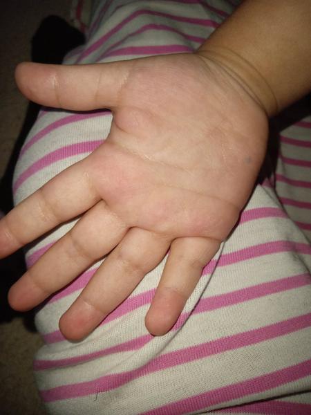 Má dcérka na chodidlách a rukách výsyp?