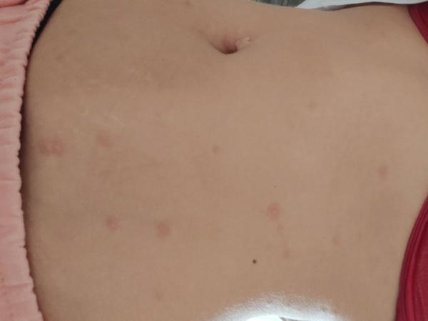 Aké sú to vyrážky?