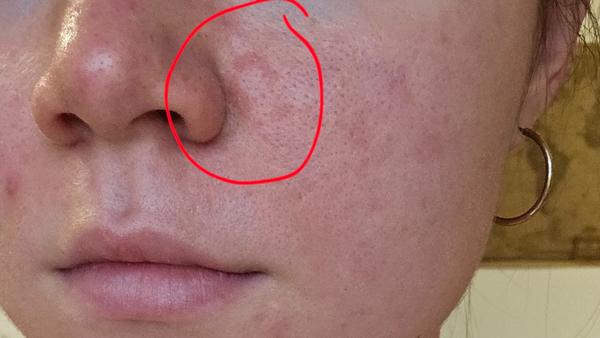 Červené šupinky v okolí nosa a medzi obočím