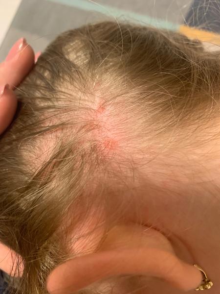 Štípance vo vlasoch