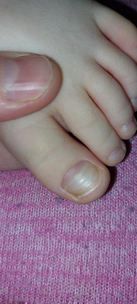 Čo spôsobuje lámanie nechtov na palcoch nôh u 3-ročnej a 10-ročnej dcérky?