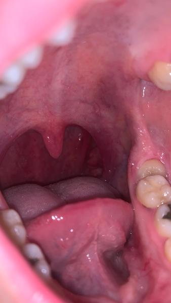 Je to kvapavka v hrdle?