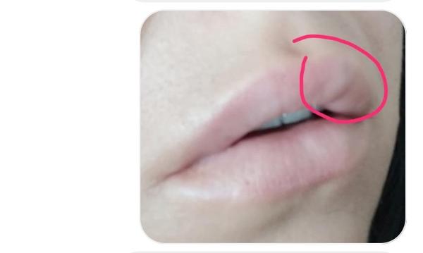 Zmizne mi hrčka, ktorá mi ostala po výplní pier?