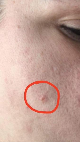 Aký kožný útvar mám na líci?