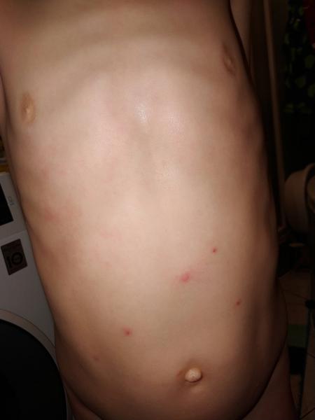 Z čoho mám vyrážky na trupe?