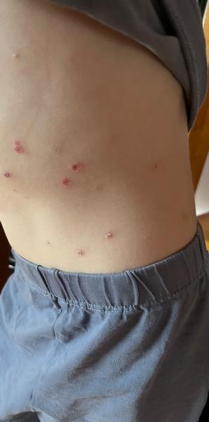 Kedy použiť krém na odpadávajúce chrasty po kiahňach?