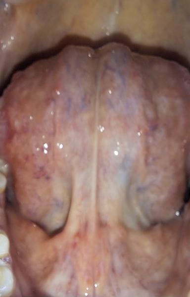 Výrazné žily na jazyku