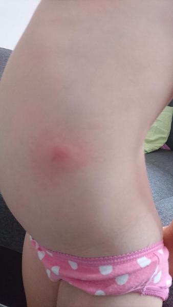 Uštipnutie komárom