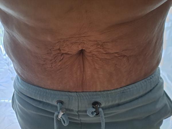 Dá sa upraviť moje brucho?