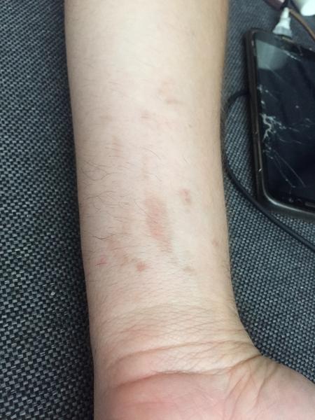 Aké fľaky má môj partner na zápästí?