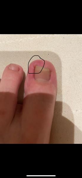 Bolesť palca na nohe