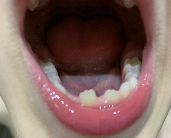 Dcérke rastie trvalý zub krivo. Je potrebná úprava u zubára?